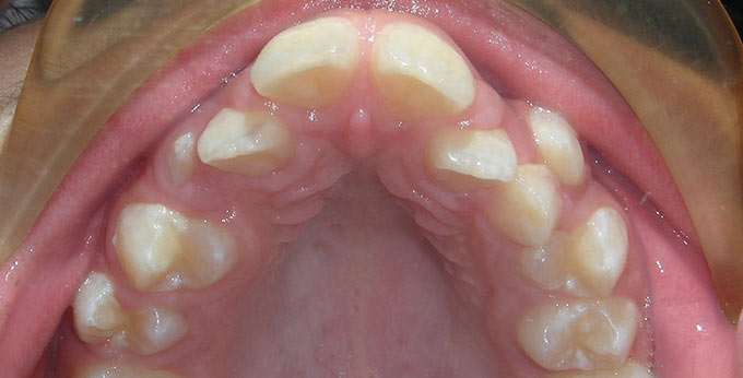 Before Orthodontic treatment consisting of removal of four premolar teeth followed by Upper braces.